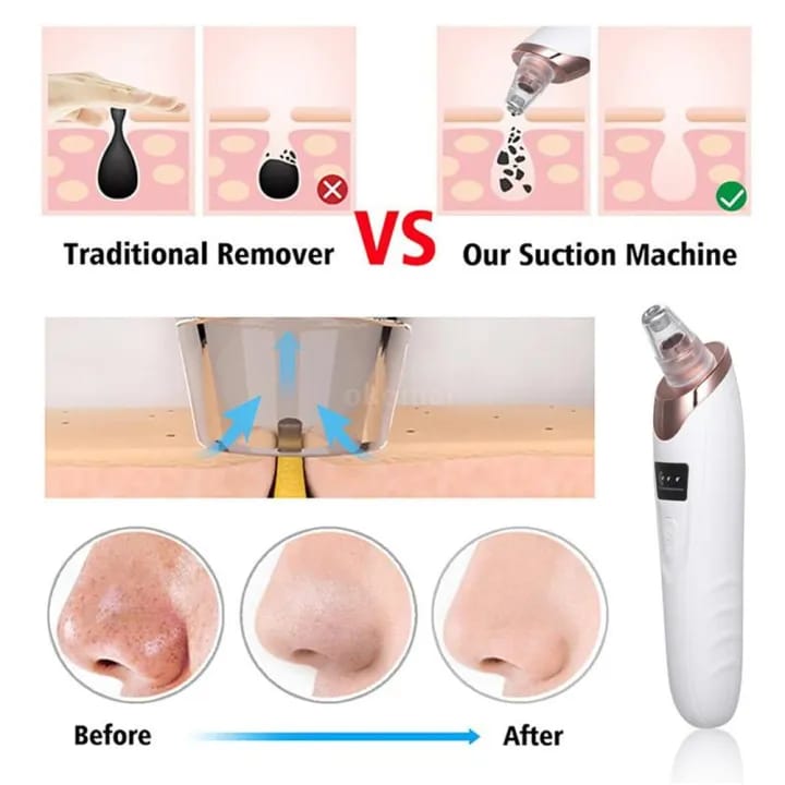 Clear Skin Confirmed: 3-Speed Face Vacuum & Blackhead Destroyer